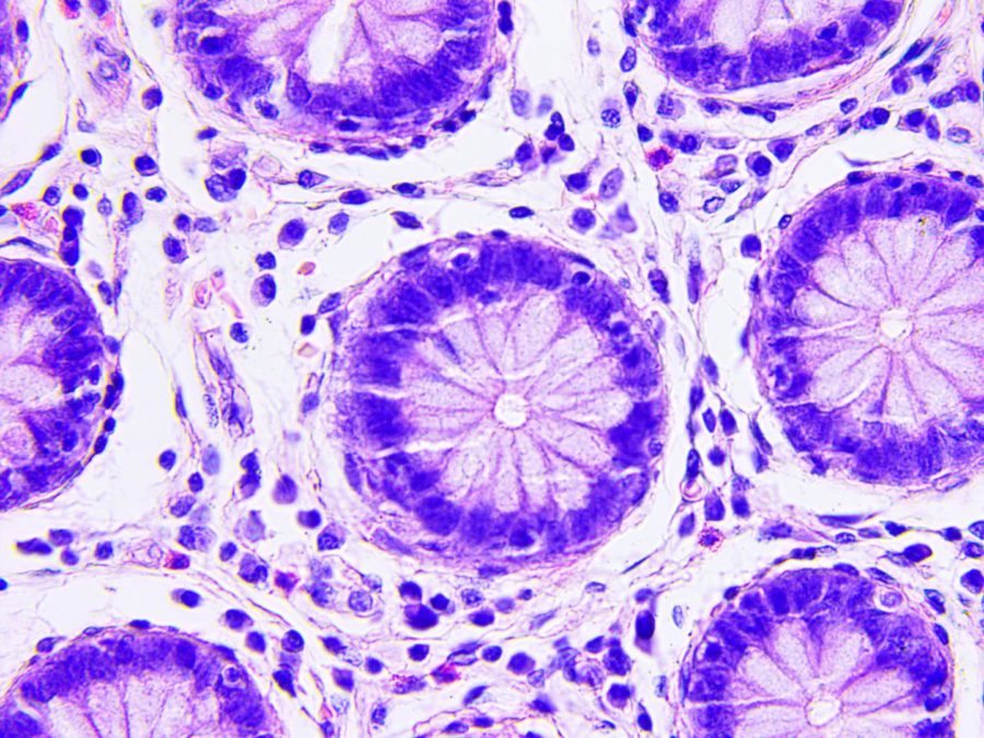An up close image of the invasive colon cancer cells in a body.